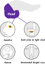 Discover 10 pancreatic cancer symptoms you should never ignore! Symptoms Of Pancreatic Cancer Managing Pancreatic Cancer Let S Win