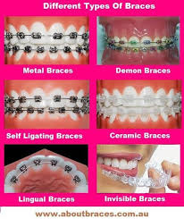 They can be a bit painful for the first few days, but it settles down quite quickly. 110 Ide Braces Dental Kawat Gigi Gigi Palsu