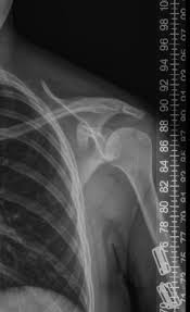 Image result for Shoulder XRay