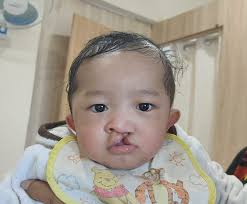 Free corrective surgery Good morning, please pass the information to the  interiors of the region that such birth defects are still corrected free of  cost at Shija Hospitals, Langol, Imphal West Manipur