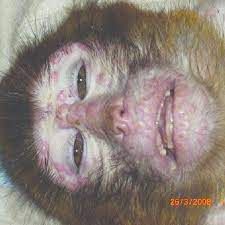 Monkeypox causes symptoms that are similar to those of smallpox. Monkeypox Virus Infected Macaca Mulatta M Mulatta With Multifocal Download Scientific Diagram