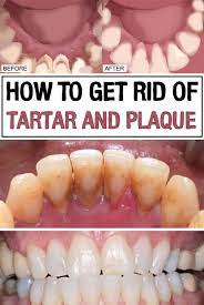 Natural Ways To Get Rid Of Tartar And Plaques That We All Must Try Homemade Remedies Healthy Smile Healthy Advice