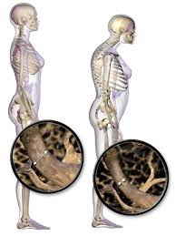 The left lumbar region is one of nine regions of the abdominal cavity, and it contains organs from both the digestive and excretory systems. Kyphoplasty Or Vertebroplasty Repair Of Vertebral Compression Fractures Joint Surgeon Com