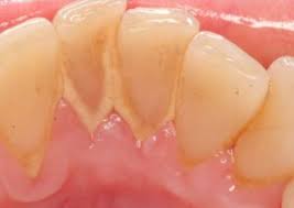 Aug 17, 2017 · take about 18 inches of floss, wrapping one end around each of your middle fingers. How To Remove Tartar Buildup Yourself