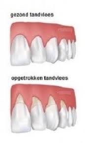 Check spelling or type a new query. Top 15 Huismiddeltjes Tegen Terugtrekkend Tandvlees Dental365 Nl