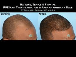 He has been offering hair transplants for over 10 years, completing more than 8,000 cases in that time. Q Does Hair Transplantation Work For Ethnic Or African American Hair Bauman Medical