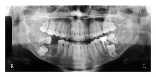 Cherubism is a rare genetic disorder (also knows as the vanmullemsyndrom) that causes prominence in the lower portion in the face. Clinical And Surgical Management Of An Aggressive Cherubism Treated With Autogenous Bone Graft And Calcitonin