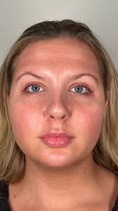 Sfillers Ruined My Face