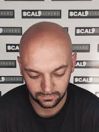 Scalp Micropigmentation in Kent