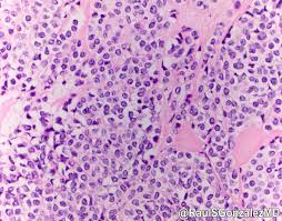Image result for Glomus tumor
