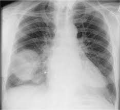 Differentiate from an elevated hemidiaphragm. Pleura Radiology Key