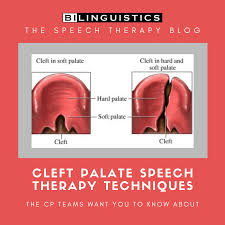 Cleft Palate Speech Therapy Techniques Clp Team Tips Bilinguistics