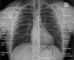 Chest X Ray Labeled Avec Images Ecg Radiologie Medicale Radiologie