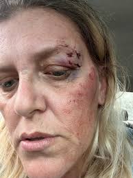 Kind if long post. Sorry How. Do you help get past the anxiety and paranoia  over it happening again? I recently had a complex grand malit was really  bad. Like i litterally