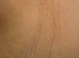 Dealing with unwanted hair is not a pain anymore! Laser Hair Removal St Louis Permanent Hair Reduction Missouri