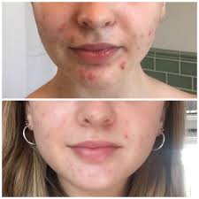 I have non alcoholic fatty liver disease. Acne My Dermatologist Keep Pushing Me To Start Accutane Advice I M Currently 2 Months Into Spiro And I Ve Seen A Decent Improvement Skincareaddiction