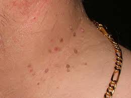 Verrugas En El Cuello Fibromas Blandos Cd Iselamendez