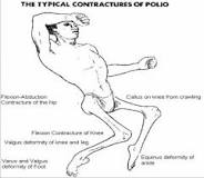 Image result for icd 10 code for hx polio