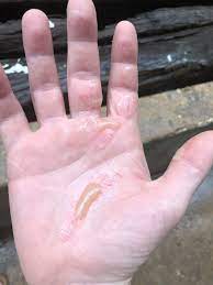 Burned My Hand With Skillet Last Night Pain Is Excruciating What Do I Do I Want To Avoid Hospitals Right Now R Firstaid