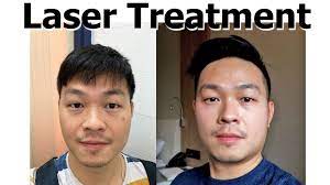 Dermatology department hospital tengku ampuan afzan, jalan tanah putih, kuantan. Laser Treatment At Lim Skin Clinic Penang Malaysia For Dark Spot Removal Youtube