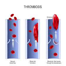 Heparin will not dissolve blood clots that have already formed, but it may prevent the. Leg Clots Aka Deep Vein Thrombosis An Immediate And Long Term Health Hazard Harvard Health