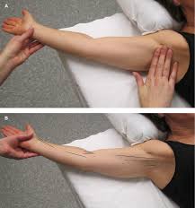 Metastatic or advanced lung cancer. Axillary Web Syndrome Following Breast Cancer Surgery Symptoms Compl Bctt