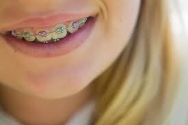 Convey More With Color What Colors Of Braces Should You Choose