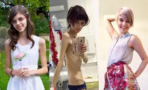 U.K. woman promotes body positivity on Insta after anorexia