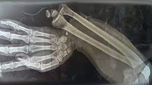 A Boy Ate 150 Gummy Vitamins For Breakfast This Is What Happened To His Bones Youtube
