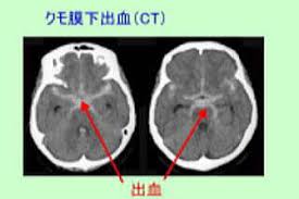 Oct 13, 2018 · 死亡リスクのほかに後遺症の危険性も高いくも膜下出血。脳動脈瘤（のうどうみゃくりゅう）が破裂するまで基本的に無症状だが、わずかな予兆. è„³æ¢—å¡ž