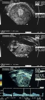 Pathologie Der Fruhschwangerschaft Springerlink