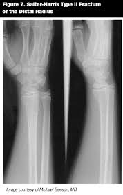 Maybe you would like to learn more about one of these? Scooter Fractures Buckle Fractures And Beyond Pediatric Hand And Wrist Injuries In The Ed 2005 08 01 Ahc Media Continuing Medical Education Publishing