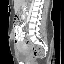 Human reproduction, vol 34, № 3. Scar Endometriosis Body Mr Case Studies Ctisus Ct Scanning