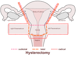 Chromosome defects, like turner's syndrome, can affect ovary formation and cause someone to experience very early menopause. Risk Factors Causes Of Early Menopause Earlymenopause Com