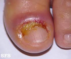 Image result for Paronychia feet