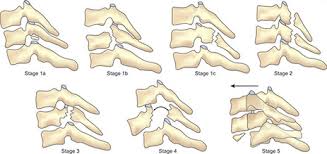 Image result for Subaxial Injury Classification Scale