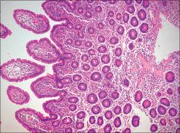 Image result for Intestinal Enteropathy