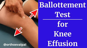 Image result for Ballottable Patella Sign