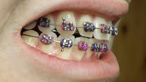 Bagi mereka yang tiada keperluan memakai braces, mereka hanya perlu ke laman sesawang untuk mencari penjual braces palsu ini. Pendakap Gigi Braces Kegunaan Dan Penjagaan The Diagnosa