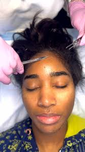 🛑DO NOT: PICK, PULL, OR SCRATCH, As your skin begins to peel, it is  tempting to pick or pull