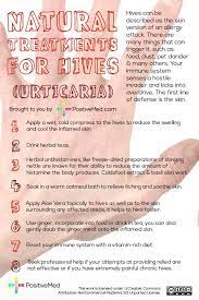 Natural Treatments For Hives | Home Remedies For Hives, Hives Remedies,  Natural Treatments