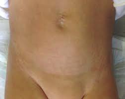An inguinal hernia occurs when the intestines or fat from the abdomen bulge through the lower abdominal wall into the inguinal, or groin, area. Cosmetic Outcome After Laparoscopic Inguinal Hernia Repair Download Scientific Diagram