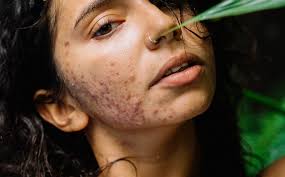 Image result for acne face