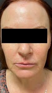 Here are a patient’s photos from before and three months after facial  thread lifting., Thread lifting works well and lies somewhere between  facial fillers, and a mini facelift. It gives better, ...