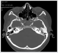 Image result for Ossicular Chain Disruption