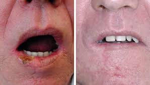 Image result for Lip Cancer