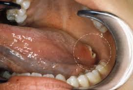 Image result for brown tongue symptoms