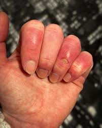 Image result for Chilblains