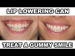 There are many ways to correct a gummy smile. Gummy Smile Correction Real Results Youtube