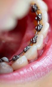 This hides them from view, making them difficult to see by others. Dental Braces Cost In Bangalore Orthodontic Treatment Charges In India